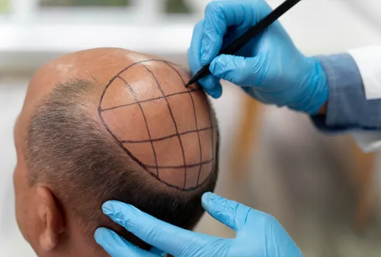Hair Restoration