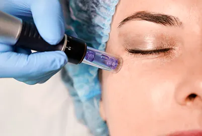 IPL Skin Treatments